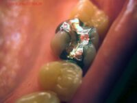 آشنایی و مضررات آمالگام ماده پرکردن دندان Dental amalgam composition