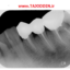 اسکنر فسفر پلیت PSP Apixia Dental Phosphor Plate Scanner Digirex دندانپزشکی رادیوگرافی مشهد