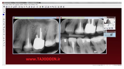 فسفر پلیت دیجیتال X-RAY DIGITAL Optime UV Phosphor Plate Scanner SOREDEX فنلاند