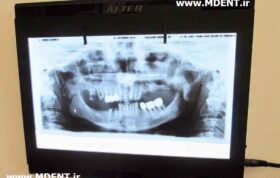 نگاتسکوپ OPG Dental x ray film viewer AJTEB MD-MLG-B عاج طب دنتال سنتر دندانپزشکی