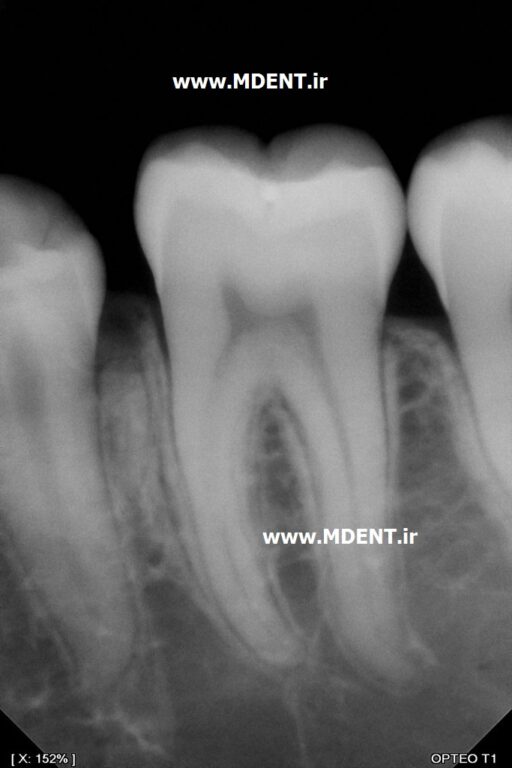 سنسور دیجیتال رادیوگرافی دندانپزشکی Owandy Opteo T2 Intra Oral Dental X Ray Sensor اواندی فرانسه