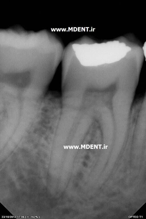 سنسور دیجیتال رادیوگرافی دندانپزشکی Owandy Opteo T2 Intra Oral Dental X Ray Sensor اواندی فرانسه