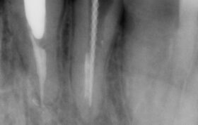 سنسور دیجیتال رادیوگرافی دندانپزشکی Owandy Opteo T2 Intra Oral Dental X Ray Sensor اواندی فرانسه