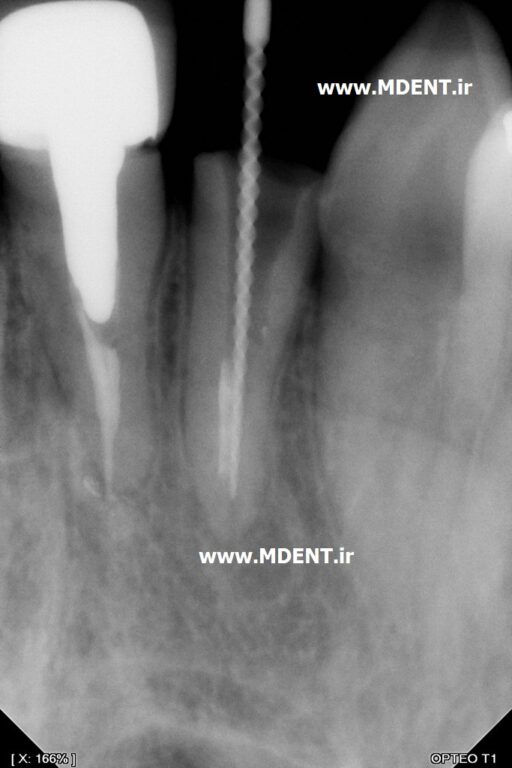 سنسور دیجیتال رادیوگرافی دندانپزشکی Owandy Opteo T2 Intra Oral Dental X Ray Sensor اواندی فرانسه