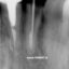 سنسور دیجیتال رادیوگرافی دندانپزشکی Owandy Opteo T2 Intra Oral Dental X Ray Sensor اواندی فرانسه