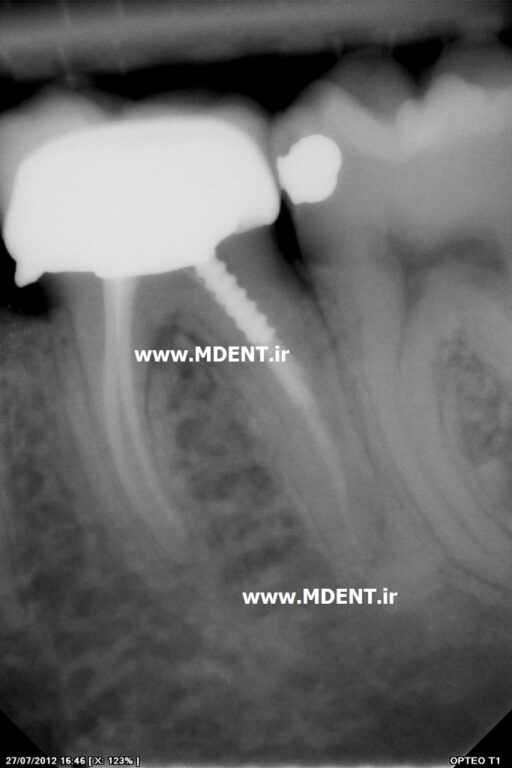 سنسور دیجیتال رادیوگرافی دندانپزشکی Owandy Opteo T2 Intra Oral Dental X Ray Sensor اواندی فرانسه