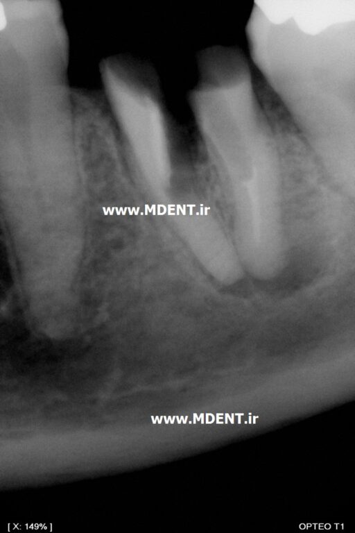 سنسور دیجیتال رادیوگرافی دندانپزشکی Owandy Opteo T2 Intra Oral Dental X Ray Sensor اواندی فرانسه