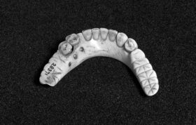 استفاده از دندان مرده‌ها برای ساخت دندان مصنوعی!
