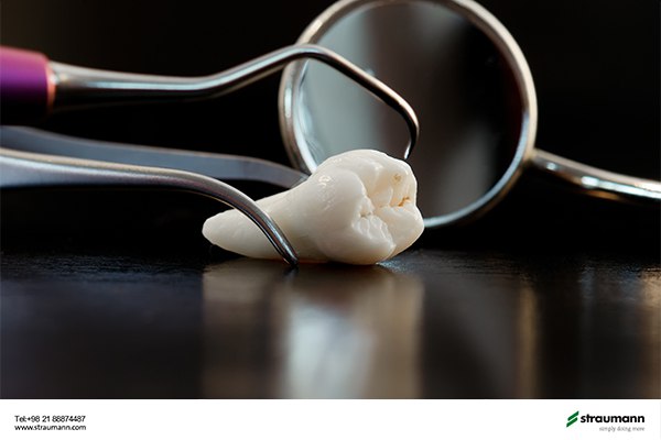 شرایط لازم برای کاشت ایمپلنت بلافاصله پس از کشیدن دندان چیست؟