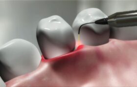 کاربرد لیزر در دندان‌پزشکی بیشتر برای جذب مشتری است!