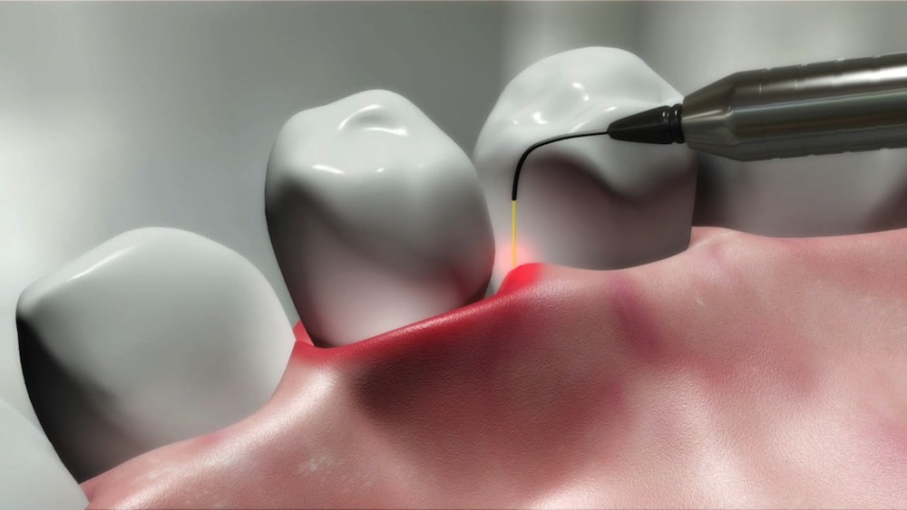 کاربرد لیزر در دندان‌پزشکی بیشتر برای جذب مشتری است!