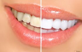 راه‌های موفقیت در یک درمان سهل و ممتنع دندان‌پزشکی زیبایی
