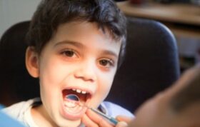 کودکان مازنی ۲برابرهمسالانشان دندان پوسیده دارند