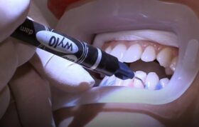 رواج خدمات غیرقانونی سفید کردن دندان در انگلستان