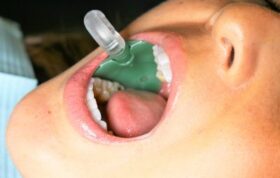 ری‌لیف، راه‌حل تمام محدودیت‌های ساکشن دندانپزشکی