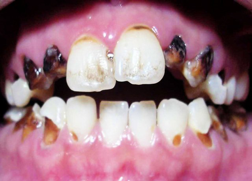 مخدرهای سنتی و صنعتی با دندان‌ها چه می‌کنند؟