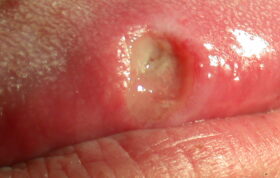 داروهای OTC و زخم‌های دهان