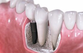 ایمپلنت باید جزو کوریکولوم آموزشی دندانپزشکی قرار گیرد