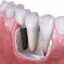 ایمپلنت باید جزو کوریکولوم آموزشی دندانپزشکی قرار گیرد
