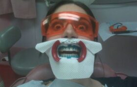 بدترین چیزهایی که دندانپزشکان از دندان بیماران‌ بیرون کشیدند!
