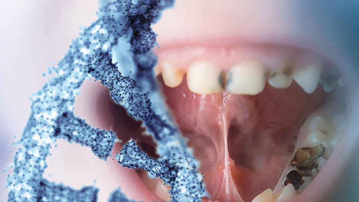 نفی ارتباط ژنتیک و پوسیدگی دندان