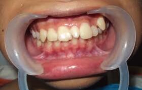 نقش دندان‌های اضافی در ناهنجاری‌های دهانی دندانی