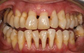«لق شدن» دندان‌ها در بزرگسالی را جدی بگیرید!