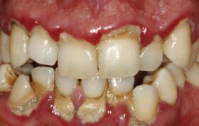 ارتباط از دست دادن دندان‌ با اختلال‌ شناختی عروقی