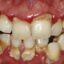 ارتباط از دست دادن دندان‌ با اختلال‌ شناختی عروقی