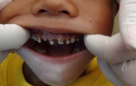 کشف ارتباط بین حوادث ناگوار دوران کودکی و از دست دادن دندان‌ها در بزرگسالی