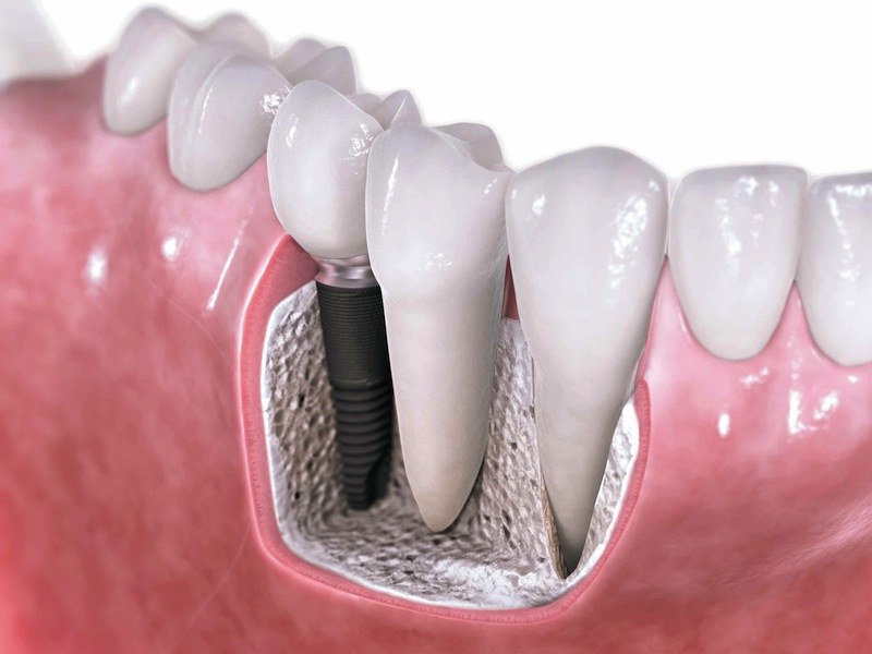 پاسخ به تمام شایعات و ابهامات درباره ایمپلنت دندانی