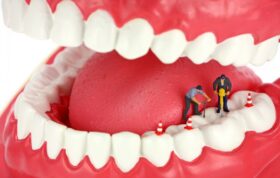 پاسخ به چند شایعه و افسانه رایج درباره عصب‌کشی دندان‌ها