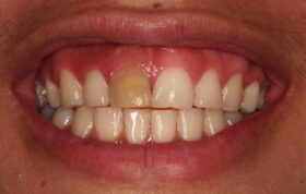 آشنایی کوتاه با بلیچینگ دندان‌های غیرزنده (درمان ریشه شده)