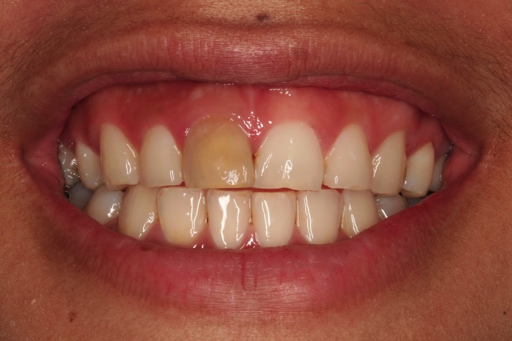 آشنایی کوتاه با بلیچینگ دندان‌های غیرزنده (درمان ریشه شده)