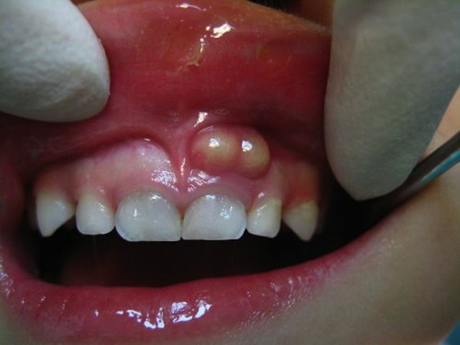 پاسخ به تمام سوالات درباره آبسه دندان