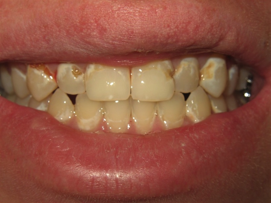دندانپزشکان در ترمیم دندان‌های پوسیده افراط می‌کنند!