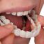 «کاور دندان»، درمان موقت برای زیبایی لبخند