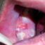 چگونه ممکن است به سرطان دهان مبتلا شویم؟