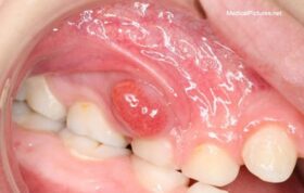 آبسه دندانی در کودکان؛ علت ایجاد، عوارض و راه‌های درمان