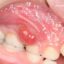 آبسه دندانی در کودکان؛ علت ایجاد، عوارض و راه‌های درمان