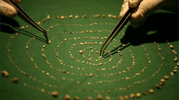 خارج کردن ۵۲۶ دندان از دهان پسر ۷ ساله