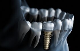 چرا برخی افراد با ایمپلنت دندانی مخالفند؟