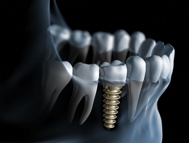 چرا برخی افراد با ایمپلنت دندانی مخالفند؟