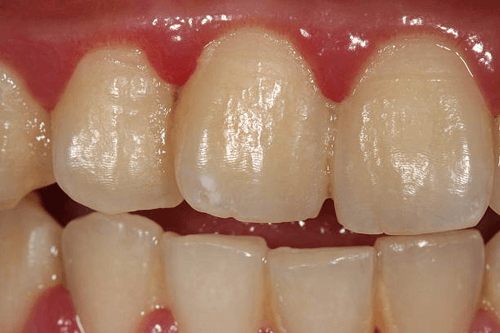 بهترین راه‌‌های پیشگیری از تجمع پلاک‌ روی دندان‌ها