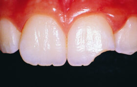اورژانس‌های ناشی از ضربه به دندان‌ها