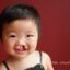 ۹۰درصد نوزادان مبتلا به شکاف کام و لب درمان می‌شوند