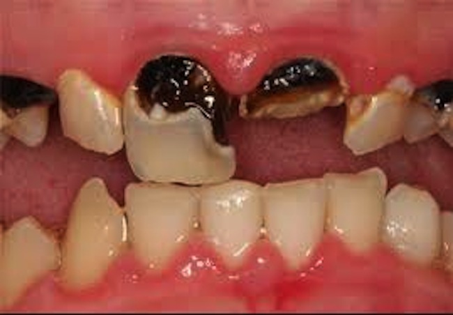 آیا پوسیدگی دندان همان کرم‌خوردگی است؟