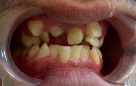 دلایل نامرتب بودن دندان‌های دائمی