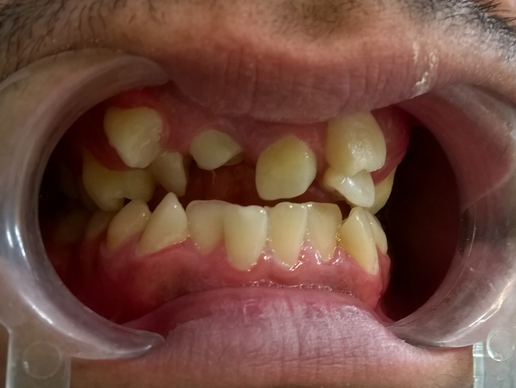 دلایل نامرتب بودن دندان‌های دائمی