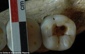 کشف اسکلت ۱۴هزار ساله با دندان ترمیم شده!